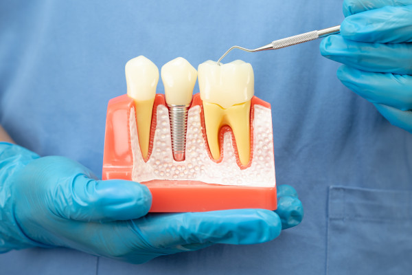 Zahnarzt hält Modell eines festsitzenden Zahnersatzes in der Hand